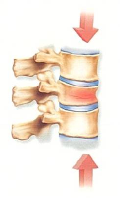 vertebral compression fracture.jpg
